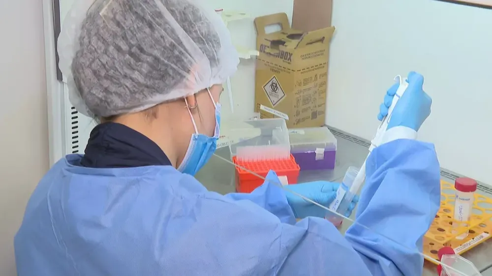 Jundiaí confirma segundo caso de monkeypox em 2024