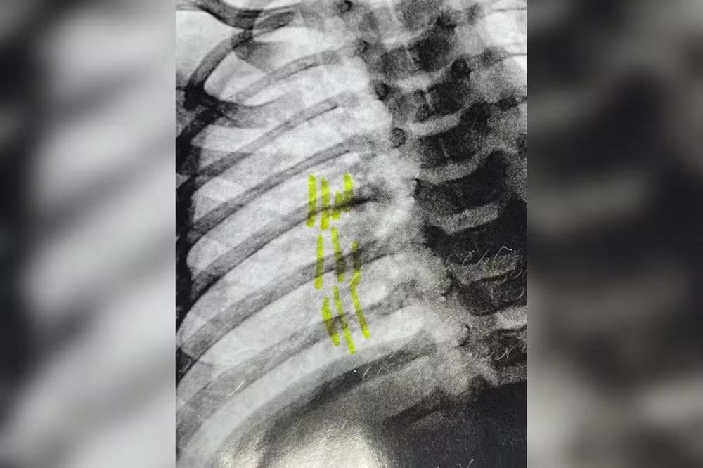 Bebê de dois meses é socorrido com ferimentos graves em Cabreúva; padrasto é preso