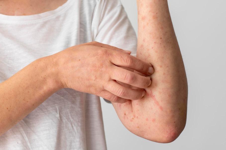 Casos de Mpox superam números de 2023 e seguem em alta no Brasil