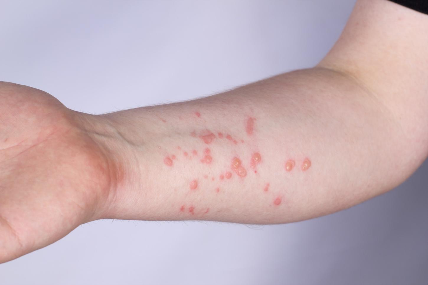 Primeiro caso de Monkeypox é confirmado em Tietê em 2024