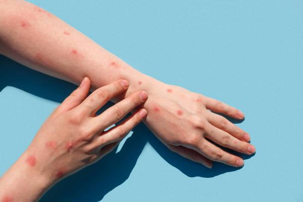 Tietê registra primeiro caso de mpox