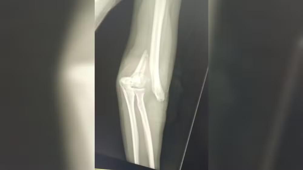 Duas jovens sofrem acidentes graves com patinetes elétricos em Votorantim