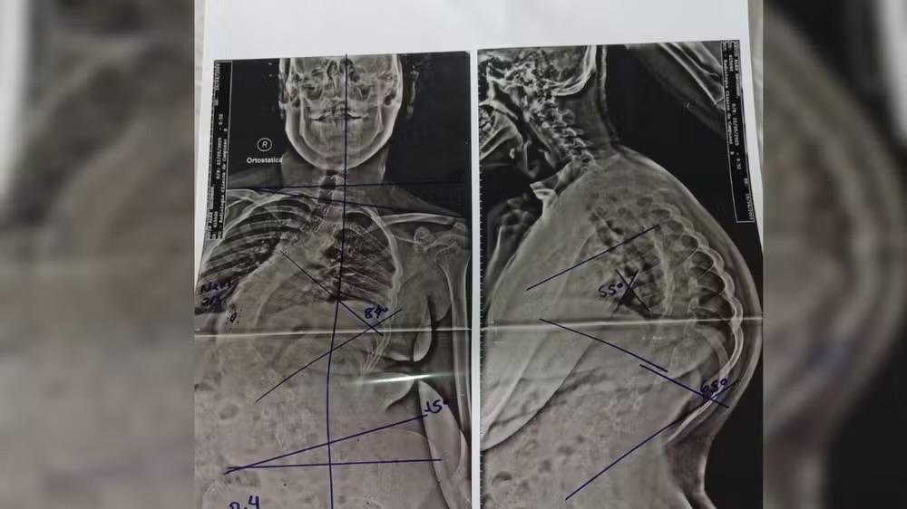 Família de Sorocaba corre contra o tempo para tratar jovem com síndrome rara