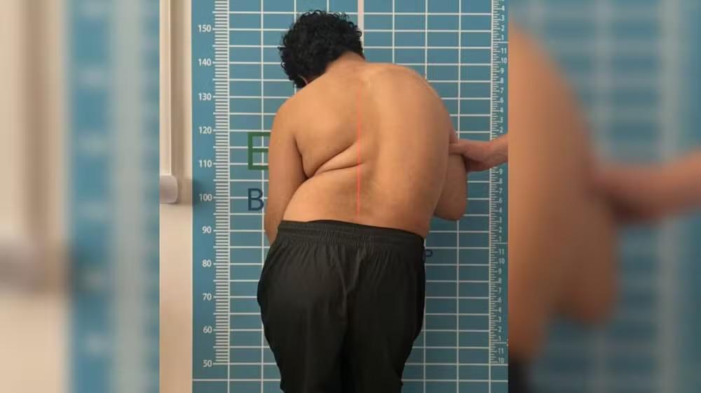 Padrasto percorre 370 km a pé para arrecadar fundos para adolescente com síndrome rara