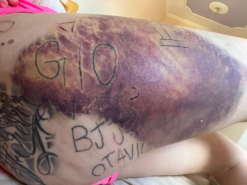 Mulher tatuada à força pelo ex-companheiro inicia remoção das marcas em Itapetininga